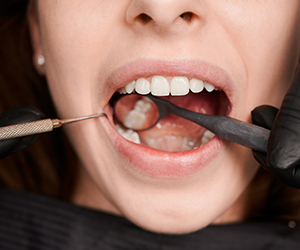 Tooth Extraction